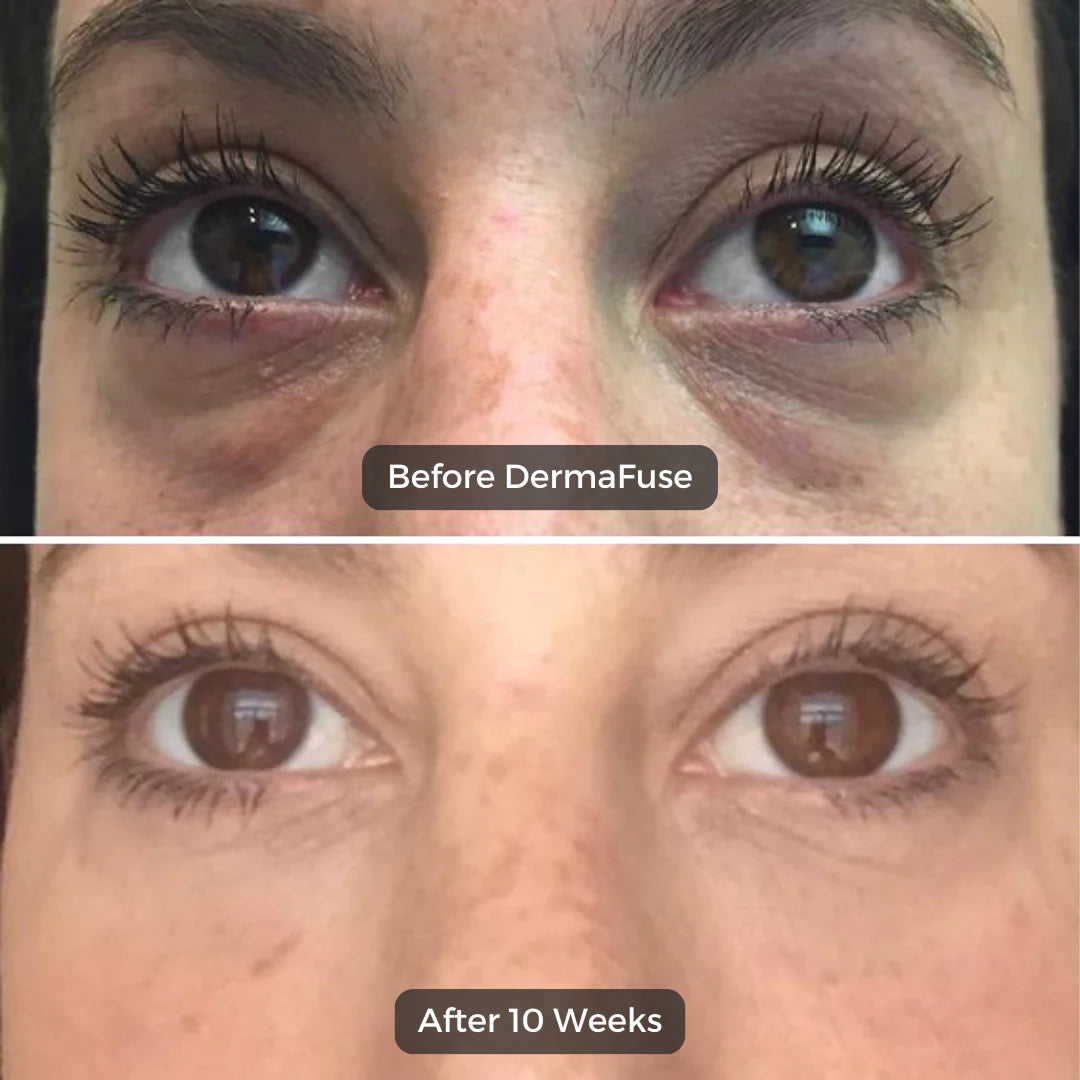 Zoropie™ Microneedle Patches
