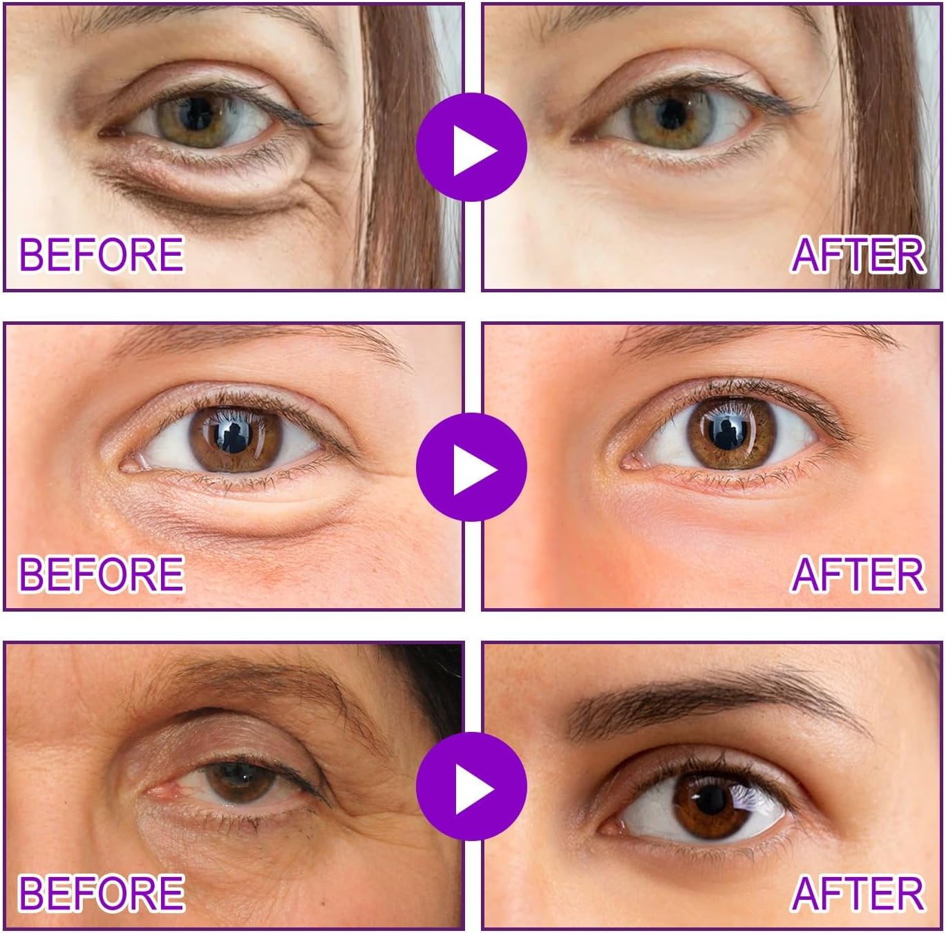 Zoropie™ Microneedle Patches